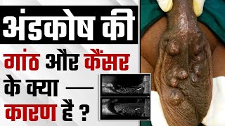 What is Testicular Microlithiasis and its Causes amp Symptoms  अंडकोष की गांठ और कैंसर के क्या कारण [upl. by Ecnadnak]