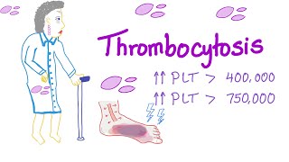 Thrombocytosis Primary and Secondary  Why Is My Platelet Count High  Hematology [upl. by Nakre]