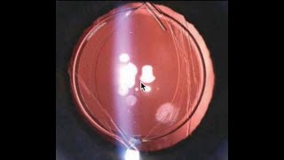 3 Cataract Postop Lecture 2024 [upl. by Nevak]