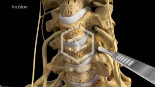 c5c6c7 Anterior Cervical Discectomy with Fusion [upl. by Auburta324]