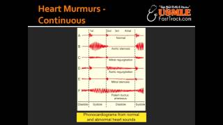 Heart Murmurs  Patent Ductus Arteriosus PDA [upl. by Sheelah249]