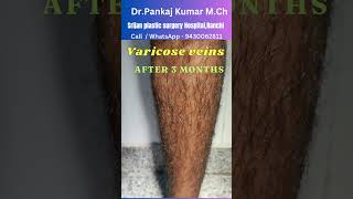 Varicose veins treatment  Result after 3 months Best varicose veins treatment for SSC GD medical [upl. by Ripleigh986]