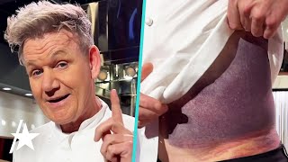 Gordon Ramsay Reveals MASSIVE Bruise After Bike Accident [upl. by Anaerb]