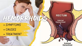 Eliminate Hemorrhoid Pain Causes Symptoms and Expert Treatments by Dr Shiraz Farooq [upl. by Meeki]