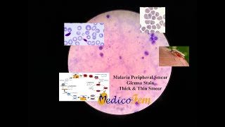 Peripheral Smear  Plasmodium falciparum  Thick and Thin Blood Smear  Giemsa Stain  Malaria [upl. by Ludeman18]