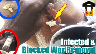 ►Extra Large Plugs Earwax Removal in Very Old Client II Satisfying Ear Cleaning with Hair Removing [upl. by Aihsital]