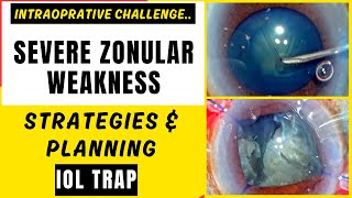 Intraoperative challenge Severe zonular weakness  Strategies amp Planning IOL Trap Technique DrDM [upl. by Yendahc]