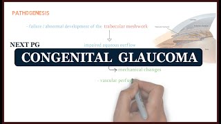 Congenital Glaucoma  ophthalmology  NEXT PG [upl. by Ettezyl]