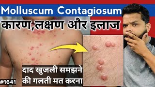 Molluscum Contagiosum Treatment In Hindi  Molluscum Contagiosum Causes And Symptoms [upl. by Ykcir81]