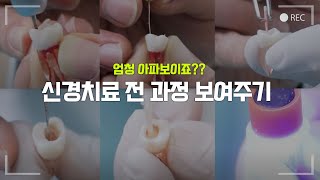 신경치료 과정 처음부터 끝까지 직접 보여드립니다 [upl. by Earezed]