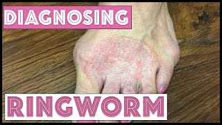 How we diagnose Ringworm Tinea Corporis [upl. by Peter]