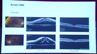 AIOC2017  Current Concepts Cystoid Macular Edema Decoded 18022017  12001325  HALL C [upl. by Magree896]