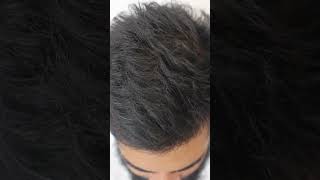 LifeChanging Results A Hair Transplant Review After 5 Months  Skinaa Clinic skinaaskincare [upl. by Hsirk]