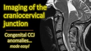 Imaging of Congenital Craniocervical Junction Anomalies [upl. by Hudnut]