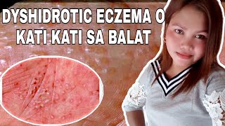 PAANO MAWALA ANG DYSHIDROTIC ECZEMA O KATI KATI SA BALAT [upl. by Eegnat357]