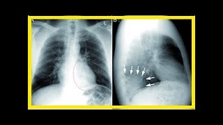 Behandlung von atypischer Pneumonie [upl. by Rdnaskela]