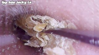 Ear Wax Removal 170 He was tormented by itchy ears every night  Ear Cleaning ASMR [upl. by Mckee]