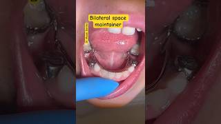 Bilateral Space Maintainer Orthodontics [upl. by Nahgrom]