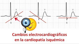 Cambios electrocardiográficos en la cardiopatía isquémica [upl. by Jannery]