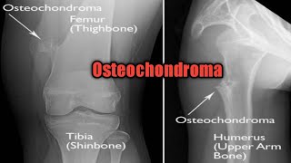 Osteochondroma  solitary and multiple pathology oncology cancer [upl. by Converse112]