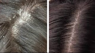 Get rid of Dandruff in Just 2 days  Know Effective Remedies 100 Working Dandruff Home Remedies [upl. by Ahsasal]