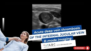 ACUTE DEEP VEIN THROMBOSIS OF THE INTERNAL JUGULAR VEIN BMODE IMAGING  ULTRASOUND [upl. by Best]