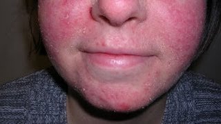 How to Treat Facial Eczema DermTVcom Epi 479 [upl. by Dloreh]