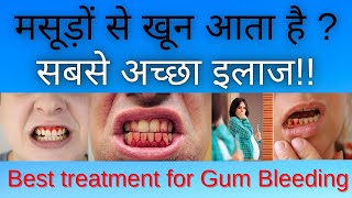 BLEEDING GUMS CAUSES  TREATMENT amp PREVENTION  HINDI   DENTAL AWARENESS [upl. by Ainsley]