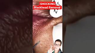 SURPRISING BLACKHEAD REMOVAL  Where Did It All Come From shorts [upl. by Ardnasirk]