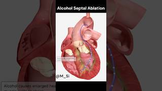 Alcohol Septal Ablation [upl. by Artied]