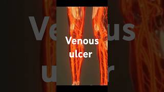 Venous ulcer thrombosismedicine healthtipshealth healthcaresymptoms treatmentvenousulcer [upl. by Eelyek]