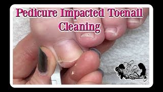 Pedicure How to Clean Impacted Toenails ⭐ [upl. by Eceined575]