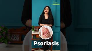 Psoriasis ko kaise Pahchane  SymptomsofPsoriasis  psoriasiskailaj shorts DrMegha [upl. by Eihs]