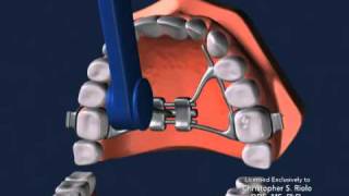 Seattle Orthodontist Dr Christopher Riolo Banded Expander RPE [upl. by Eiuqnom]