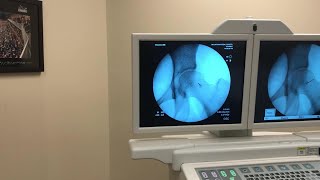 IntraArticular Injection of the Hip Under Fluoroscopic Guidance [upl. by Rammaj]