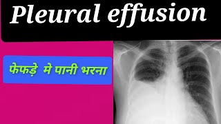 Pleural effusion ये कारण है आपके फेफड़े मे पानी भरने का। [upl. by Esidnac]