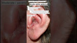 Acute otitis externa [upl. by Annaj691]