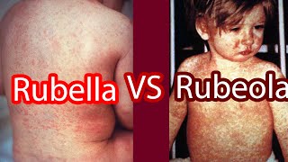 Rubella vs Rubeola Measles vs German Measles [upl. by Kirst]