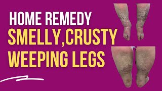 Home Remedy for SMELLY CRUSTY and WEEPING legs [upl. by Prasad775]