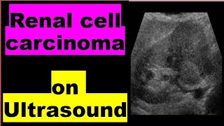 Renal cell carcinoma on Ultrasound [upl. by Mora492]