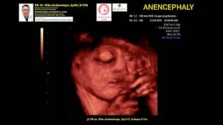 Anencephaly TM 3 [upl. by Osnohpla]