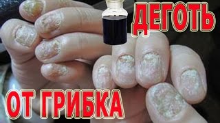 ★Деготь березовый для лечения грибка Рецепт мази с дегтем для лечения МИКОЗА [upl. by Beatriz]