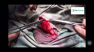 Hydrocele Operation doctor hospitaldoctor nursing [upl. by Soilissav]