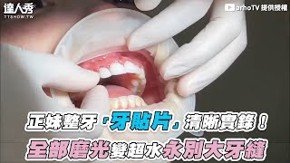 【正妹整牙「牙貼片」清晰實錄！ 全部磨光變超水永別大牙縫】｜arhoTV [upl. by Berkie]