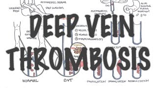 Deep Vein Thrombosis  Overview pathophysiology treatment complications [upl. by Ellis205]