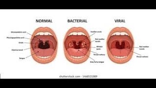 Pharyngitis Part 1 Viral Pharyngitis [upl. by Arlynne]