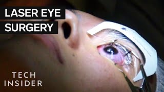 What Its Like To Get Laser Eye Surgery [upl. by Earazed888]