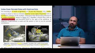 Ep 93 Gastroschisis7series case study counselling  Dr Khaled Salah gastroschisis counselling [upl. by Stepha586]