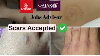 Scars Accepted Emirates Cabin Crew Requirements Explained [upl. by Nylg]