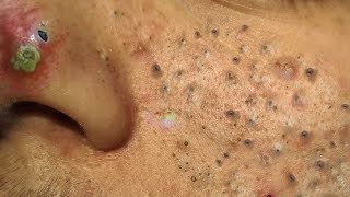 Blackhead Removal With Sac Dep Spa 100074097 [upl. by Recor]